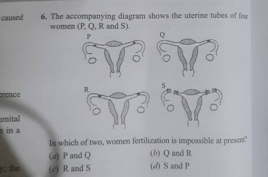 The Accompanying Diagram Shows The Uterine Tubes Of Four Women P Q R A