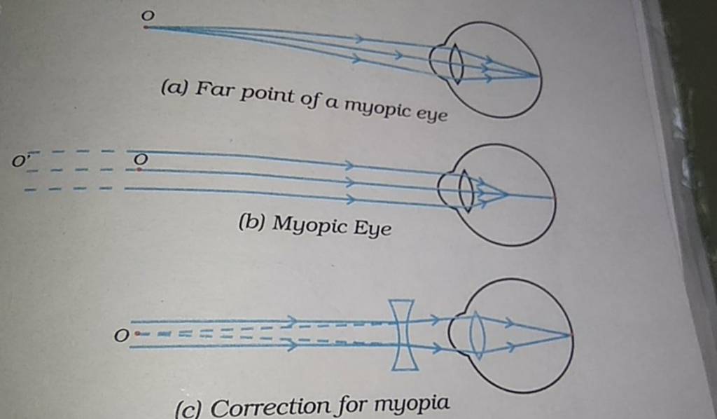 O (a) Far Point Of A Myopic Eye (b) Myopic Eye (c) Correction For Myopia